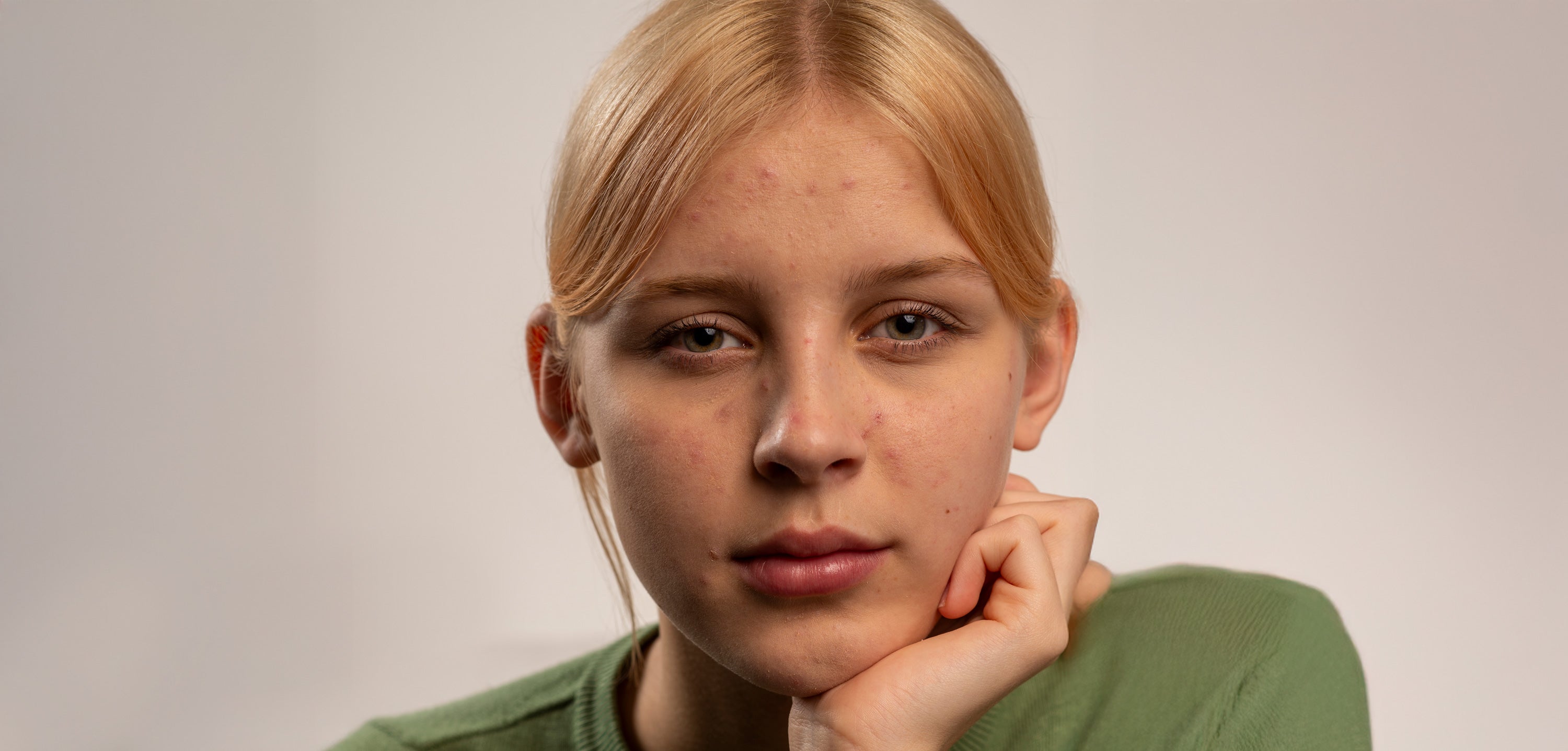 5 Essential Products to Target Blemishes